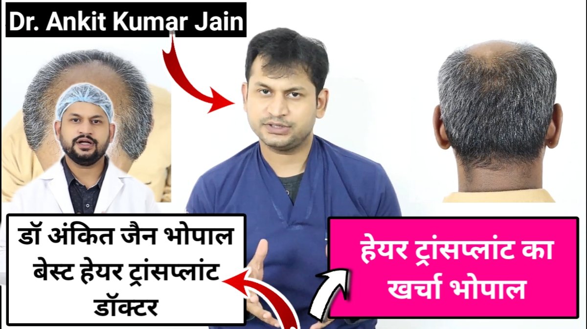 Hair Transplant Cost Bhopal Dr. Ankit Jain Bhopal हेयर फ्री हेयर ग्रो भोपाल
